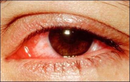 Các bệnh về mắt khi bơi